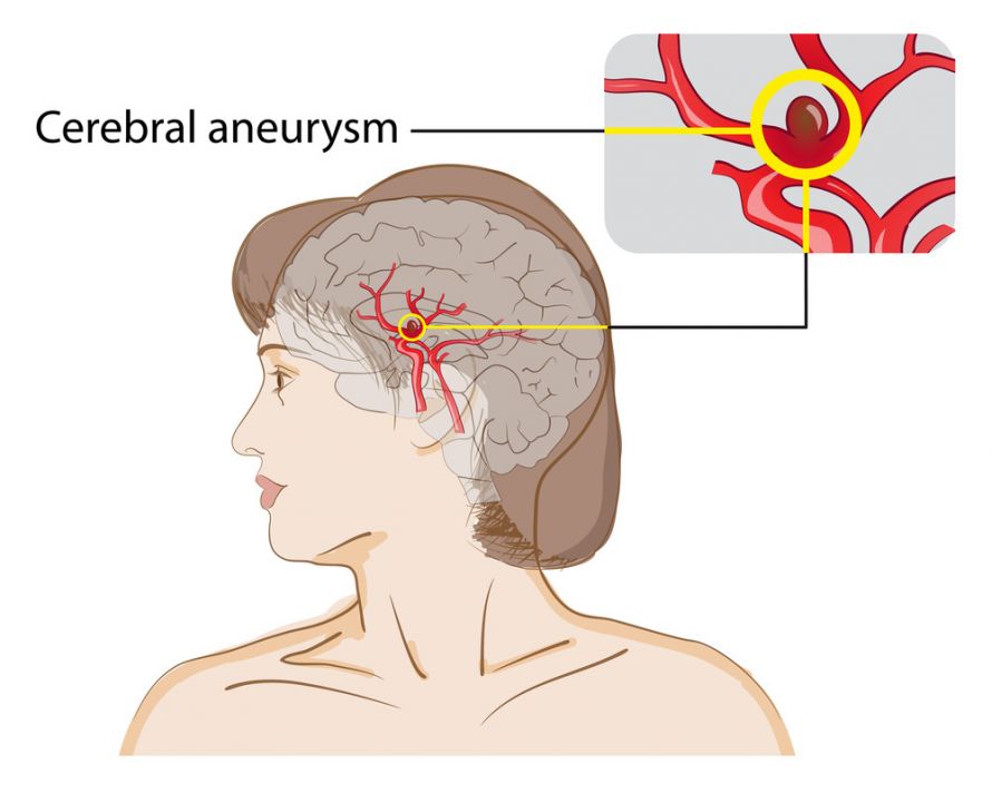 Zerebrales Aneurysma